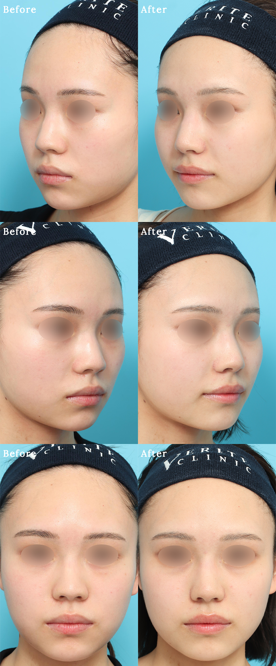 鼻翼縮小のビフォーアフターの症例画像