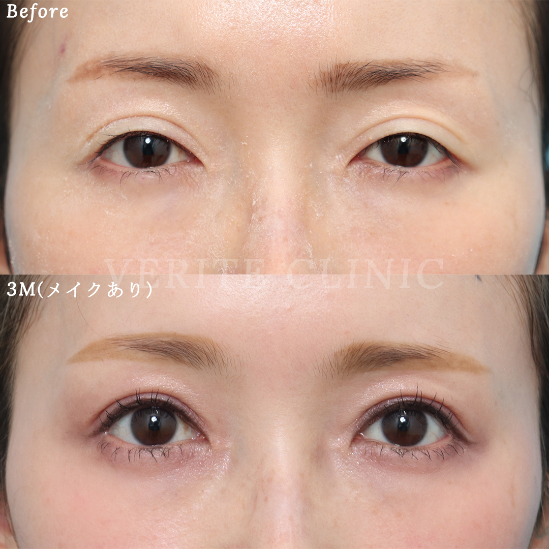 眼瞼下垂術で目の開きが悪い二重をナチュラルなぱっちり二重へ