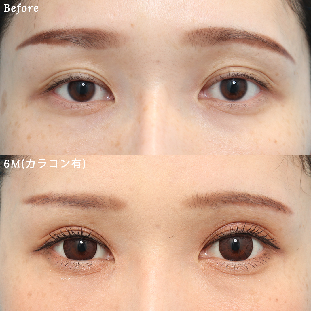 上眼瞼リフトで印象的なぱっちり二重へ