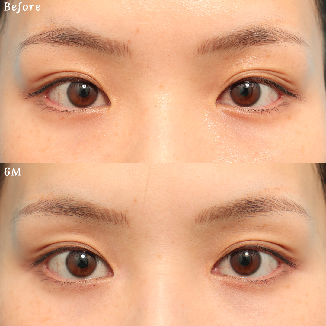 目頭切開で蒙古襞を広げて綺麗な二重へ