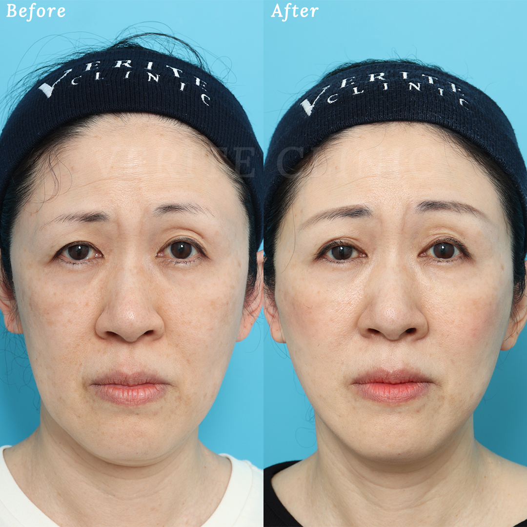 たるみを糸リフトでリフトアップ。小顔＋ぱっちり二重の美人顔へ