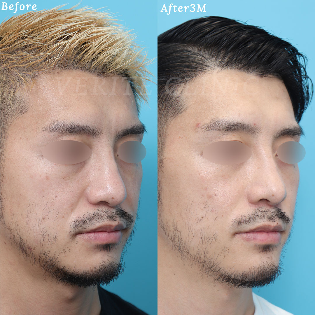 疲れた印象から明るい印象へ。プロテーゼ挿入で中顔面陥没を解消