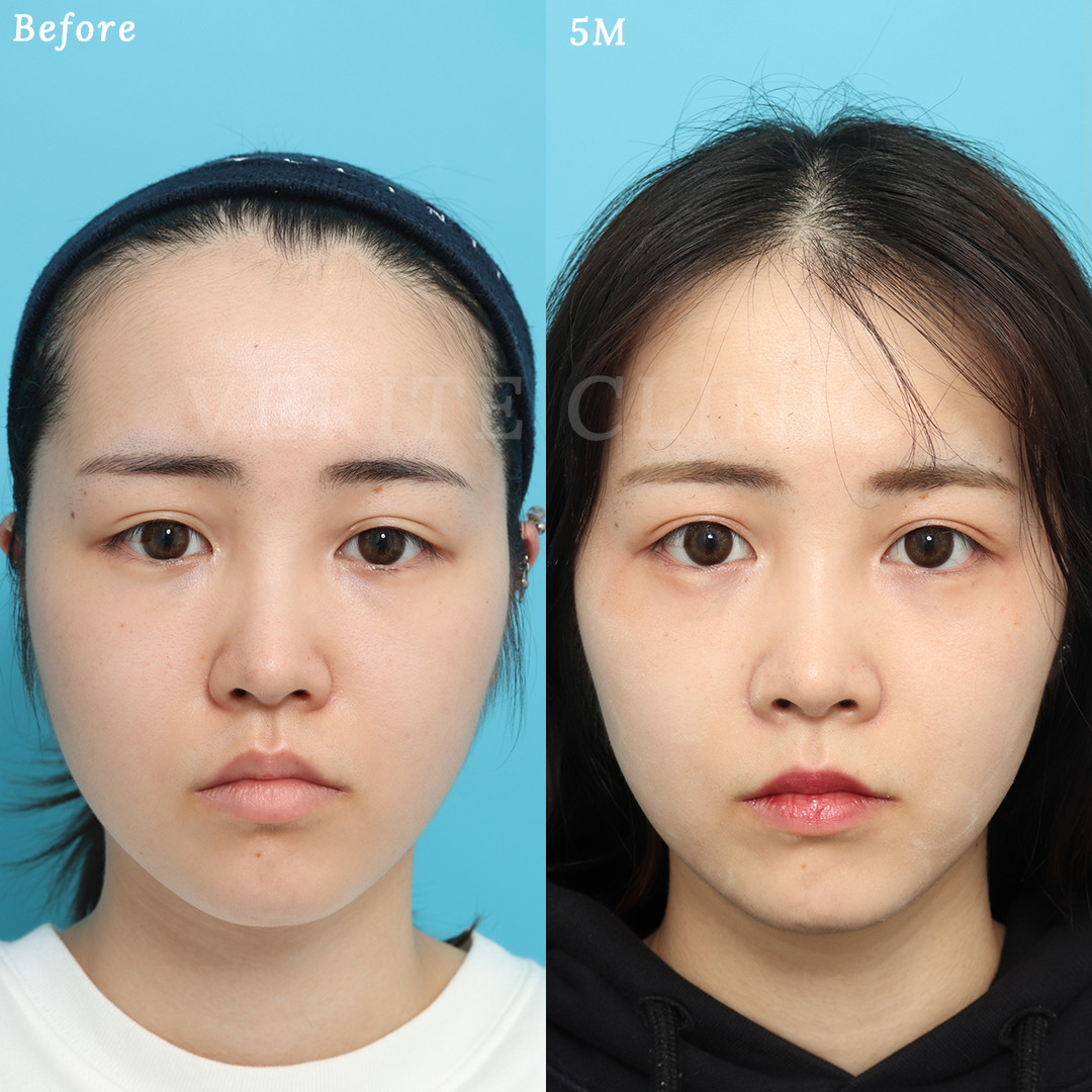 鼻整形でプロテーゼ挿入＋タレ目形成で目鼻立ちが可愛らしい顔立ちに