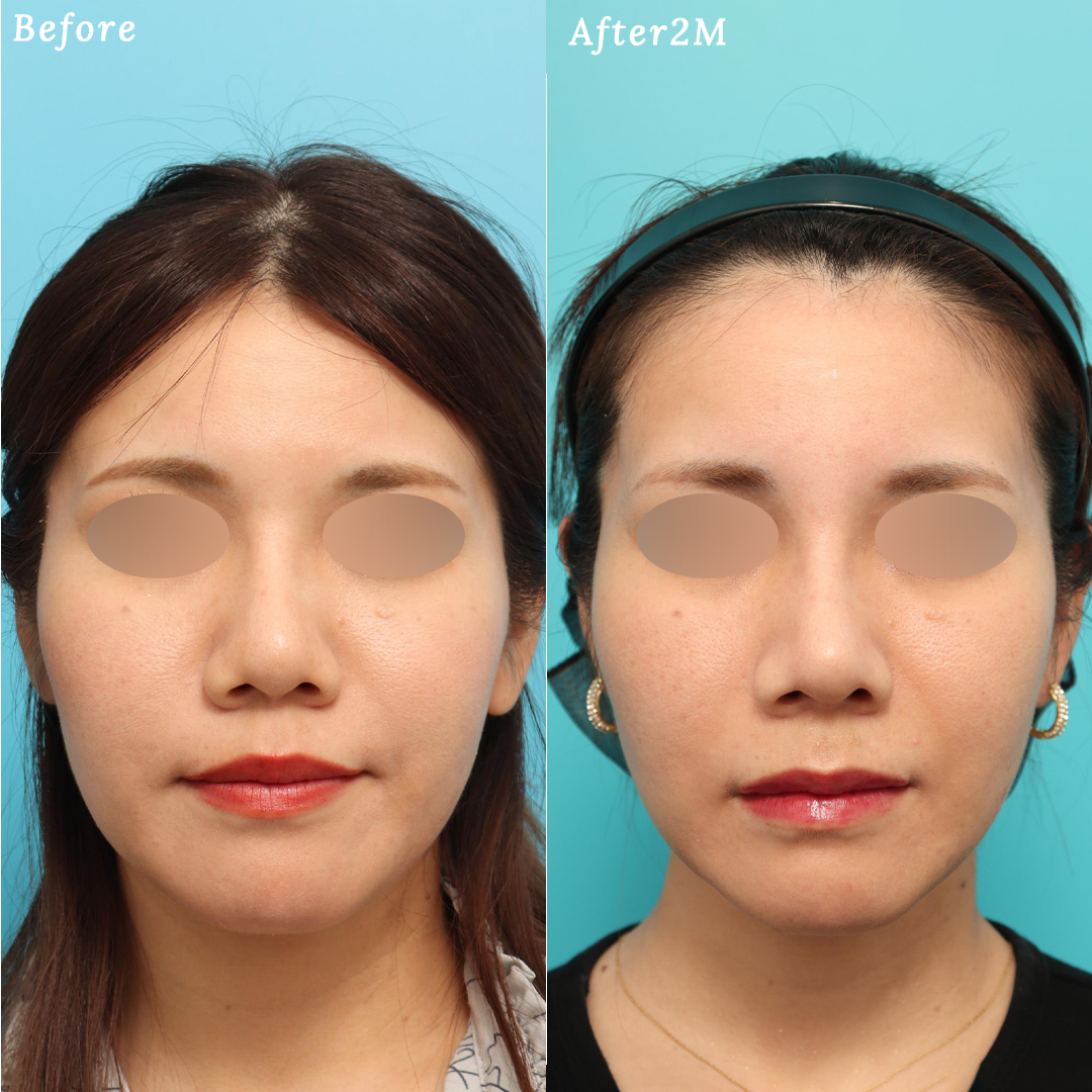 鼻整形で鼻筋の通った綺麗な鼻＋Eラインが整った横顔美人へ
