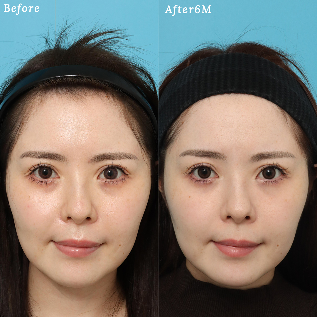 裏ハムラ＋ミッドフェイスリフトで目の下のたるみを解消