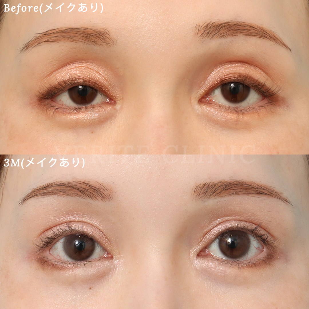 【他院修正】眼瞼下垂術で幅広くなった二重を狭く