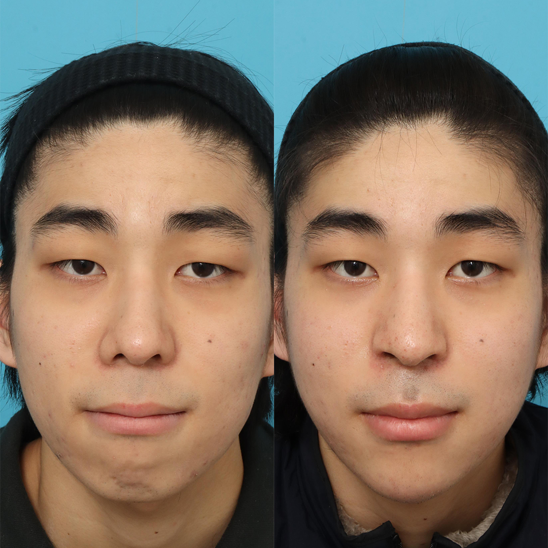 鼻孔縁挙上と鼻翼挙上でACRを理想的な形態に