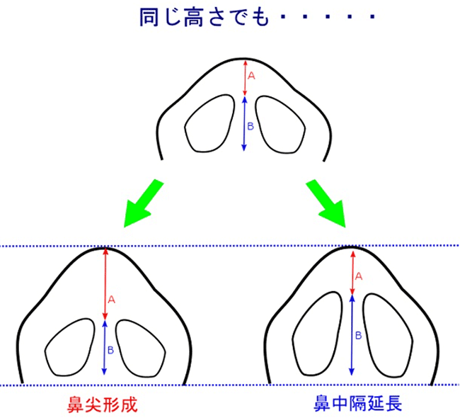 鼻中隔延長と鼻尖形成のイラスト
