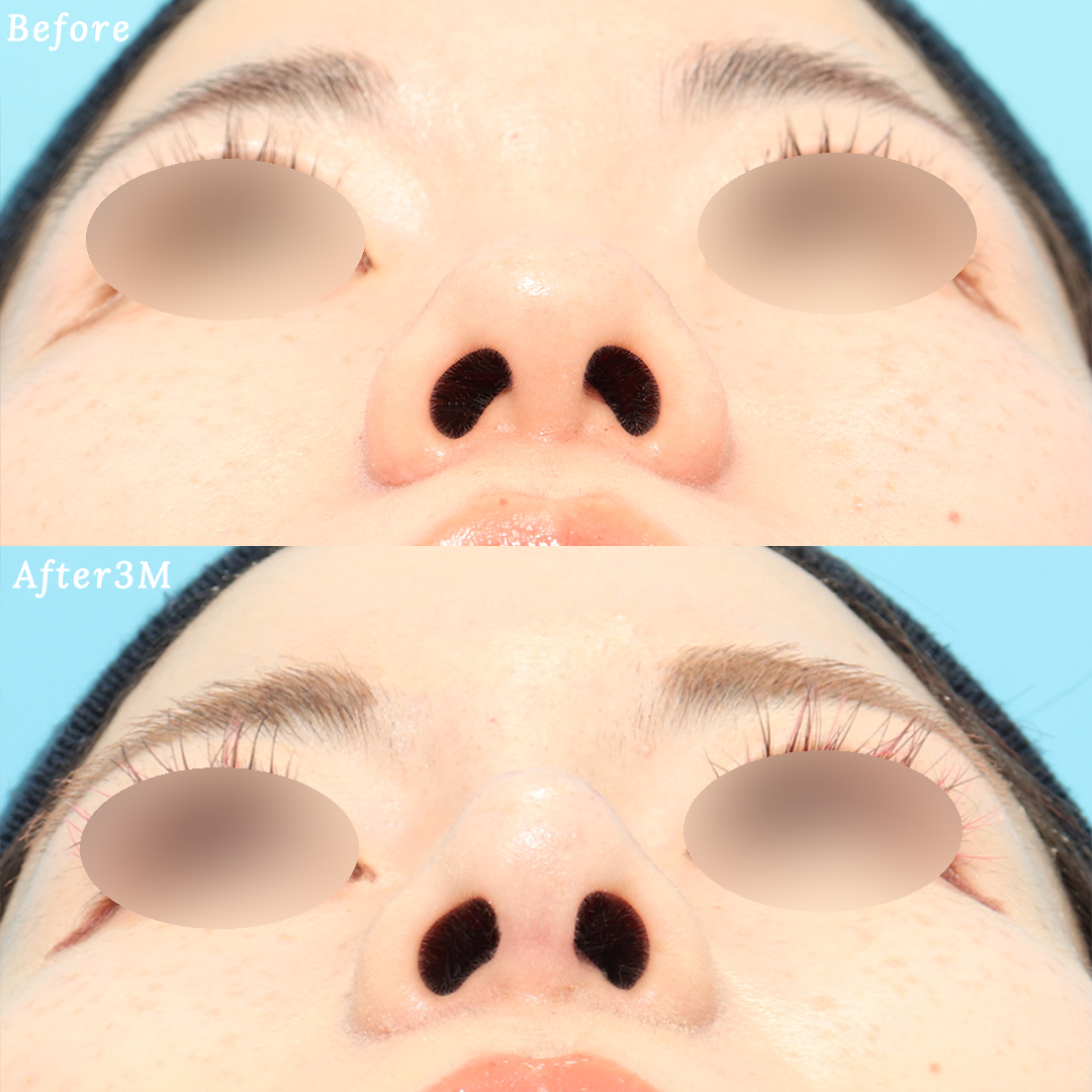 鼻フル整形ののビフォアフターの症例画像（あおり）