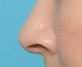 鼻孔縁形成術のアフター(横顔)