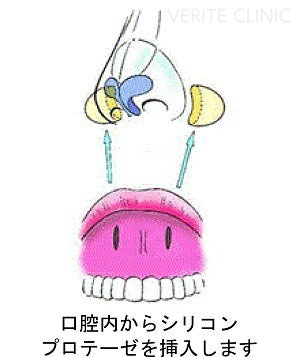 口腔内から鼻翼基部プロテーゼを挿入