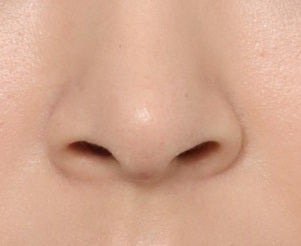鼻孔縁形成術のアフター
