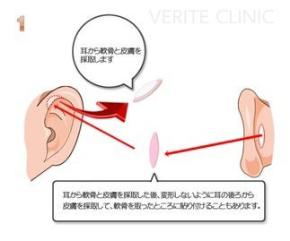 コンポジットグラフトを採取する場所