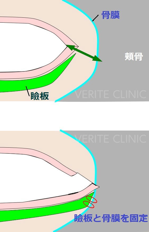 目尻切開のイラスト