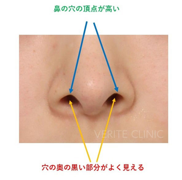 鼻の穴の頂点が高いタイプ