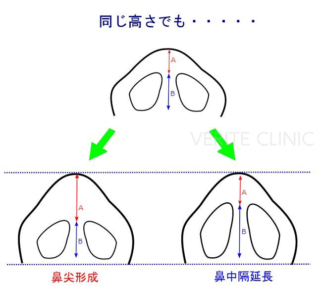 鼻中隔延長と鼻尖形成の延びている部分の違い