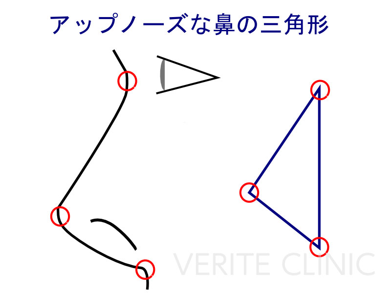 アップノーズな鼻の三角形