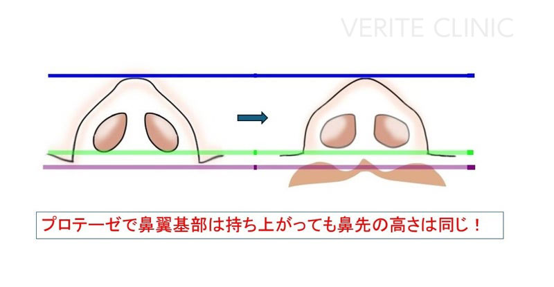 プロテーゼで鼻翼基部は持ち上がっても鼻先の高さは同じ