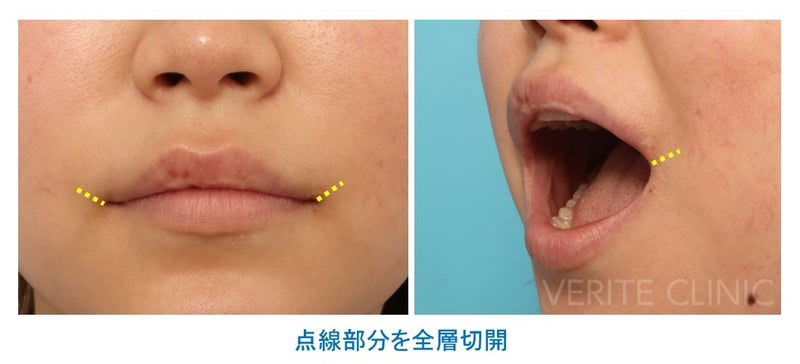 口角を斜め上方に切開する口角挙上