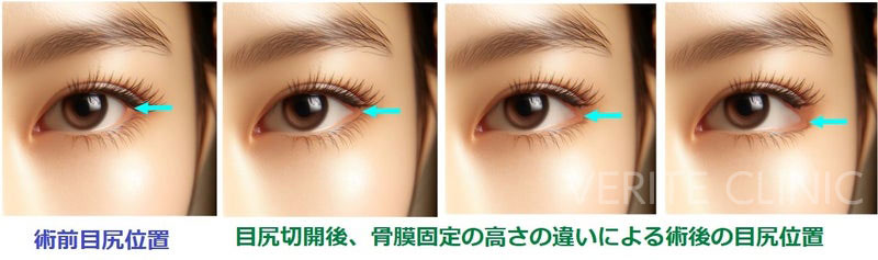 目尻切開の目尻の高さの違い
