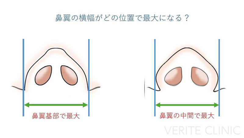 鼻翼の横幅がどの位置で最大になるか