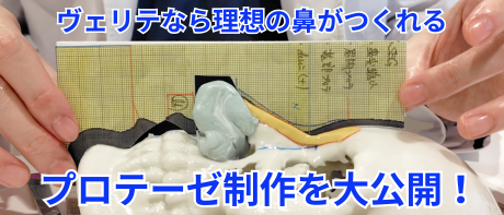 【奥目と下膨れを治療】頬骨セットバック＋糸リフト